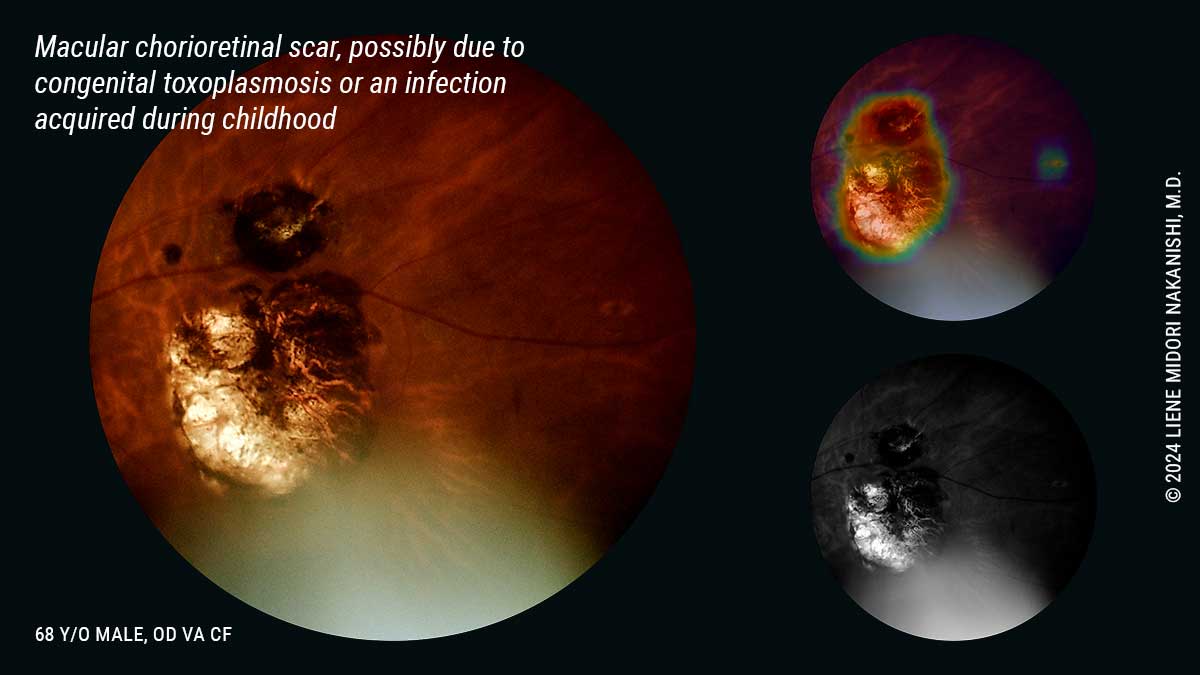 Cicatriz macular coriorretiniana